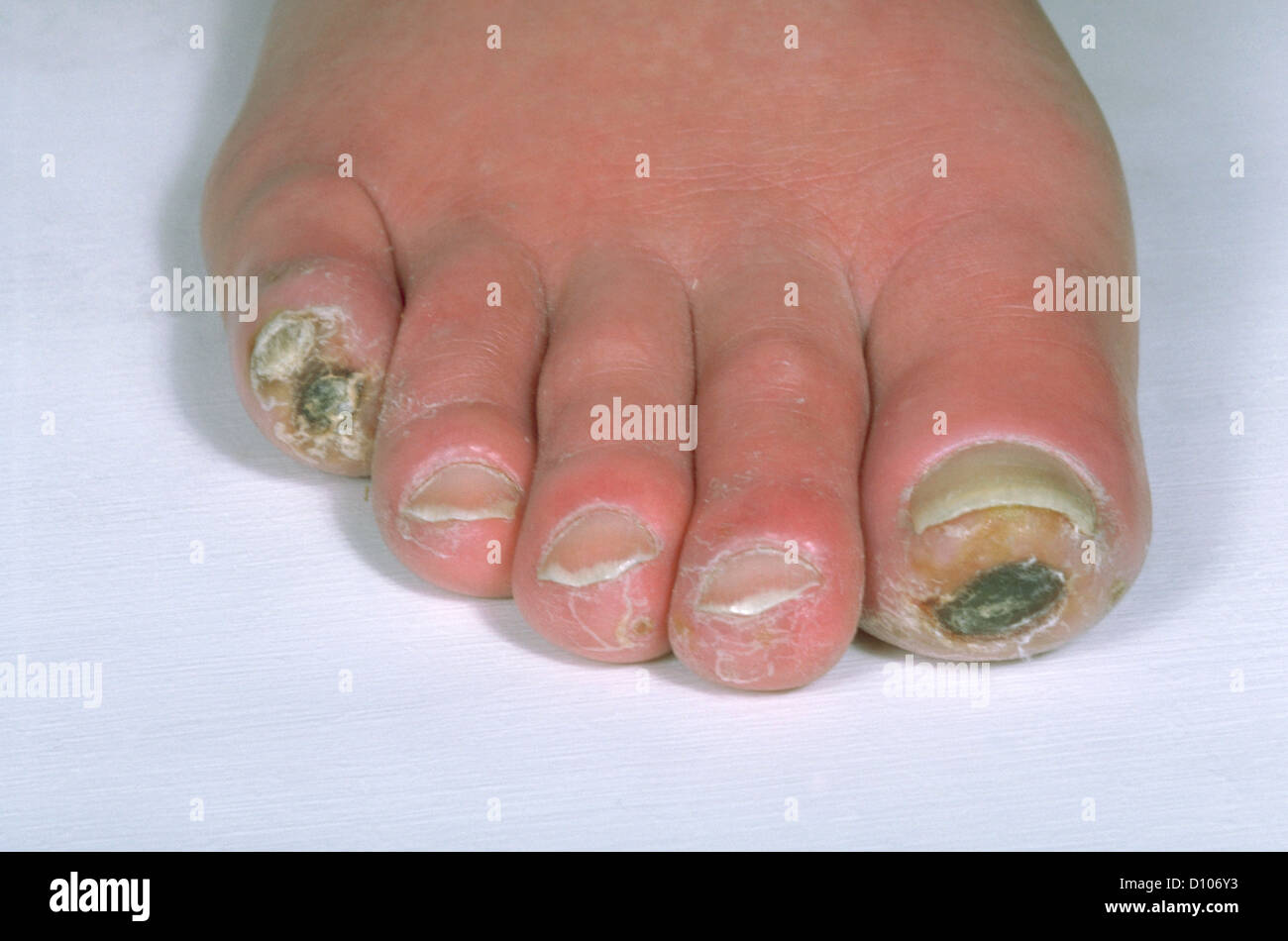 ISCHAEMIC ULCERS ON THE TOES Stock Photo