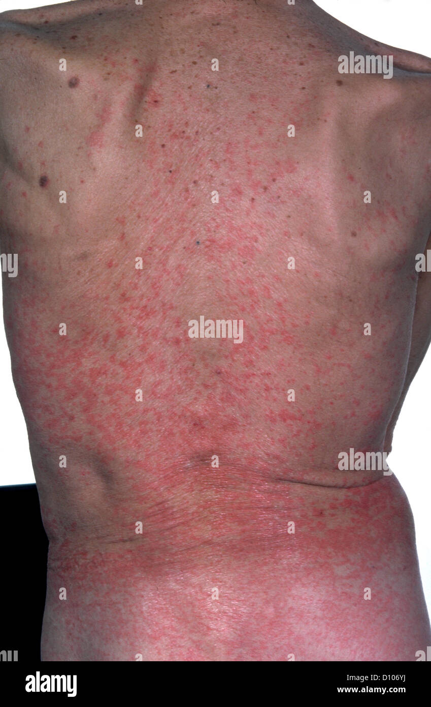 Penicillin Allergy Rash Stock Photo Alamy