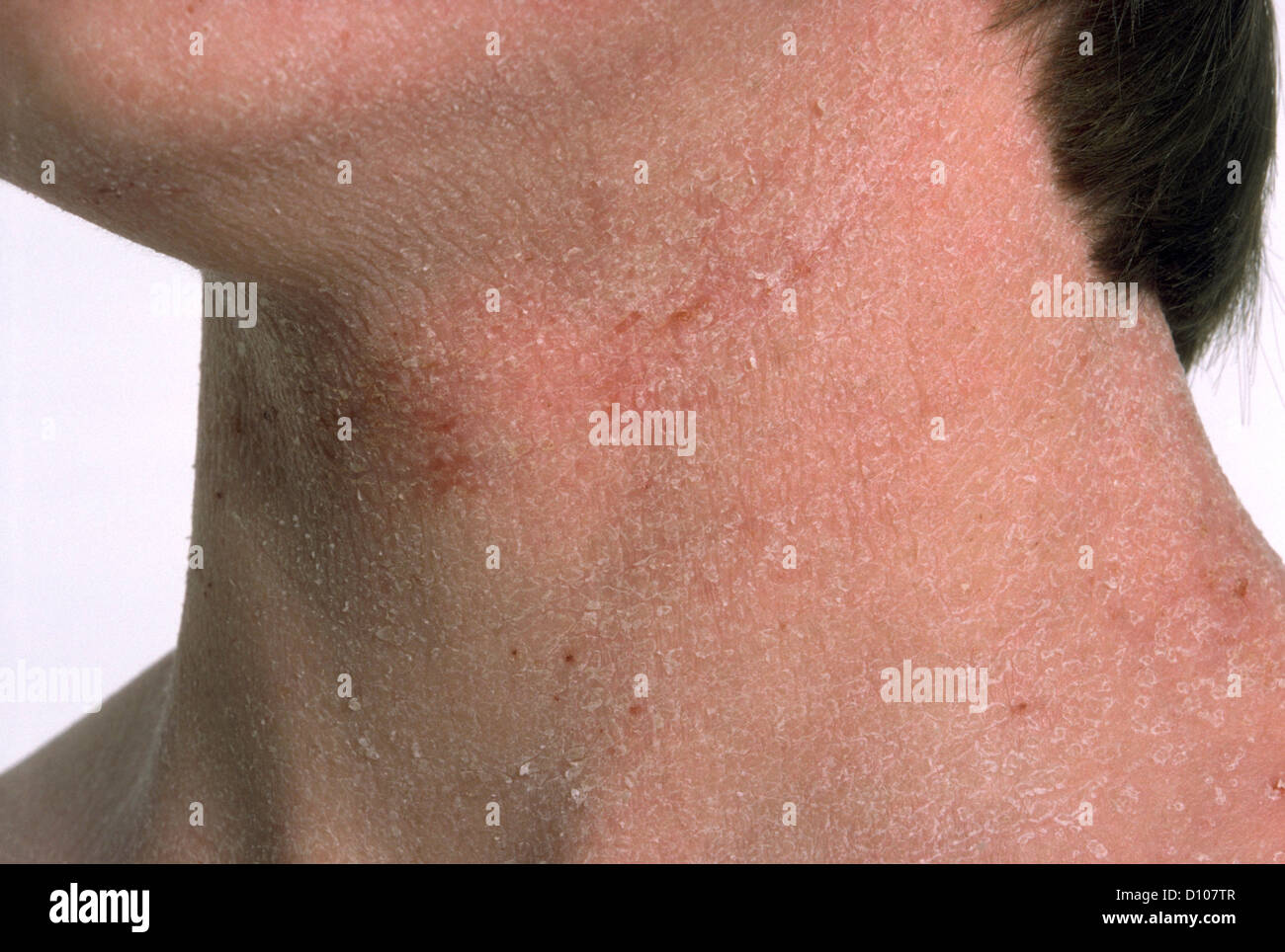 ECZEMA Stock Photo