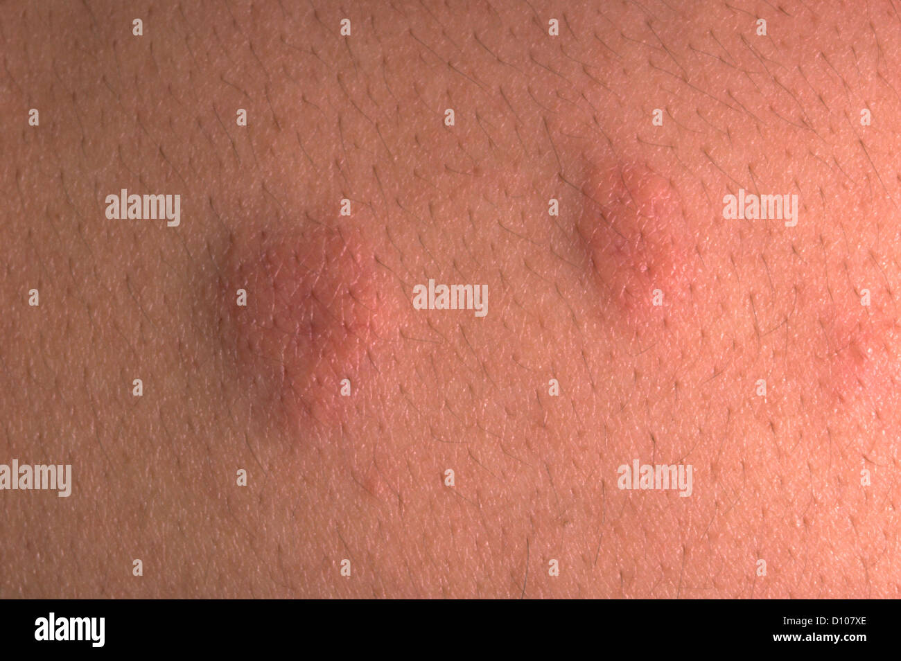 CUTANEOUS SARCOIDOSIS Stock Photo: 52251990 - Alamy