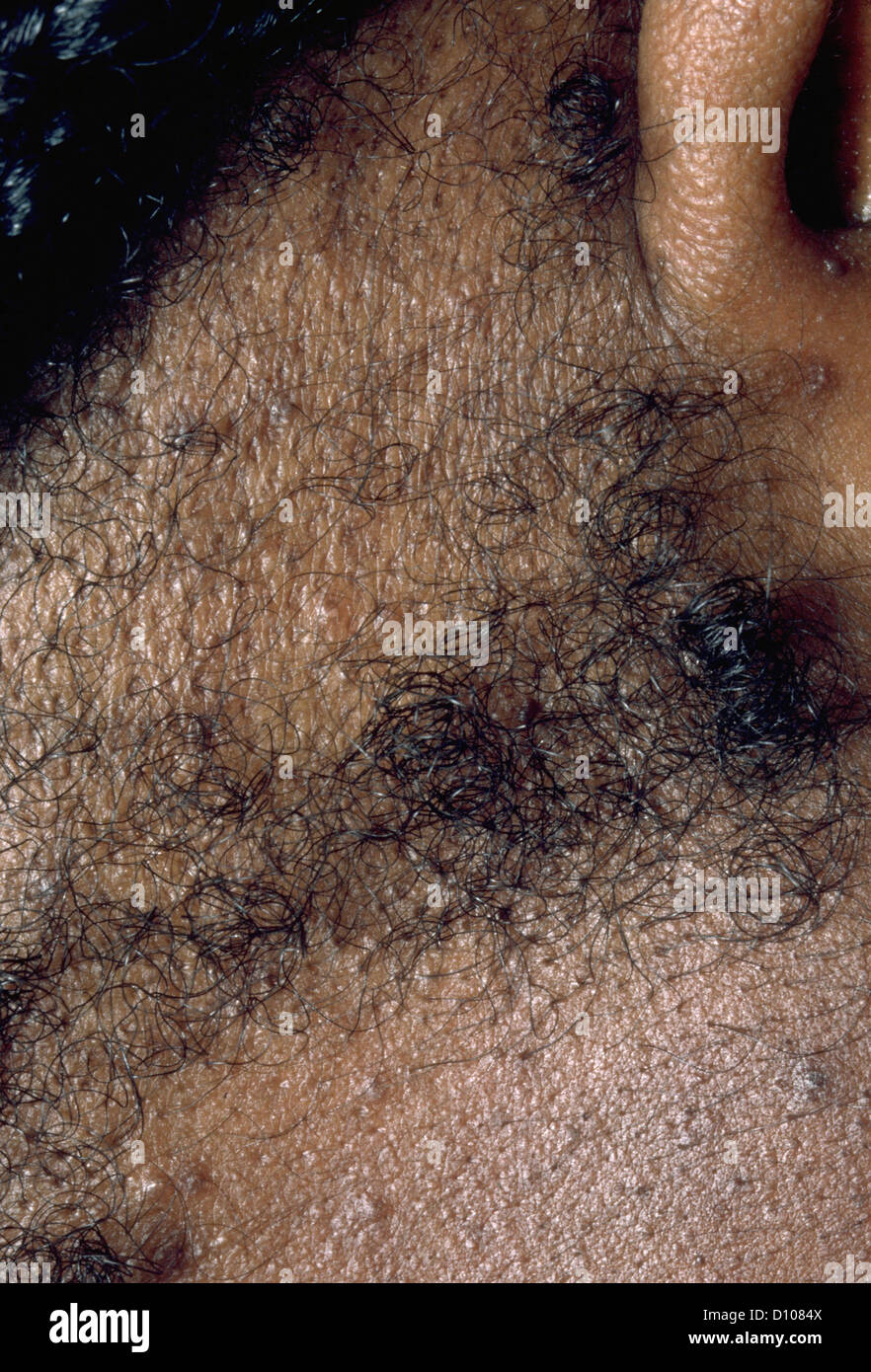 TRACTION ALOPECIA Stock Photo Alamy