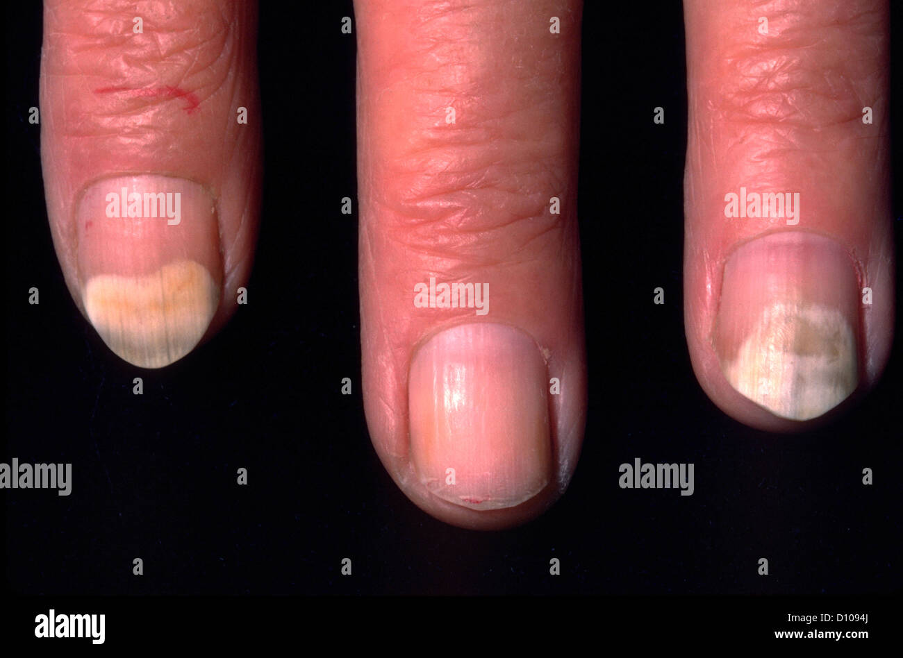 ONYCHOLYSIS Stock Photo - Alamy
