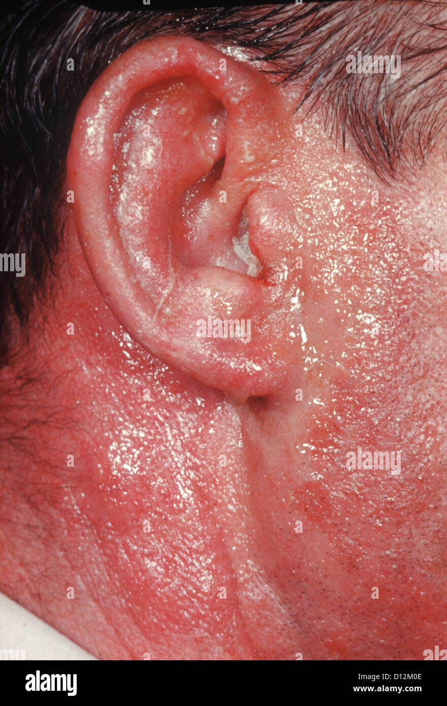 OTITIS EXTERNA Stock Photo