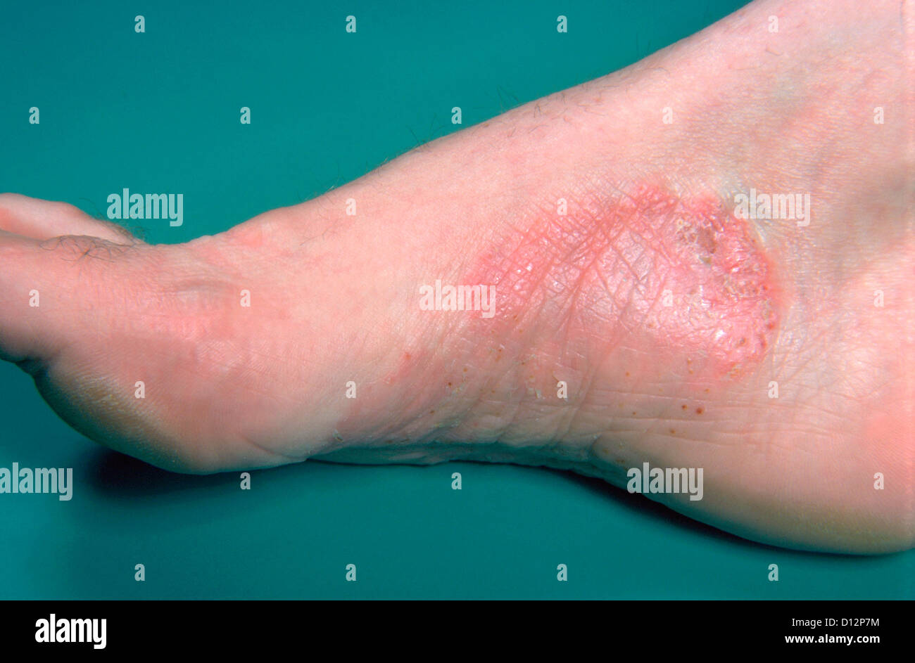 PSORIASIS ON FOOT Stock Photo Alamy