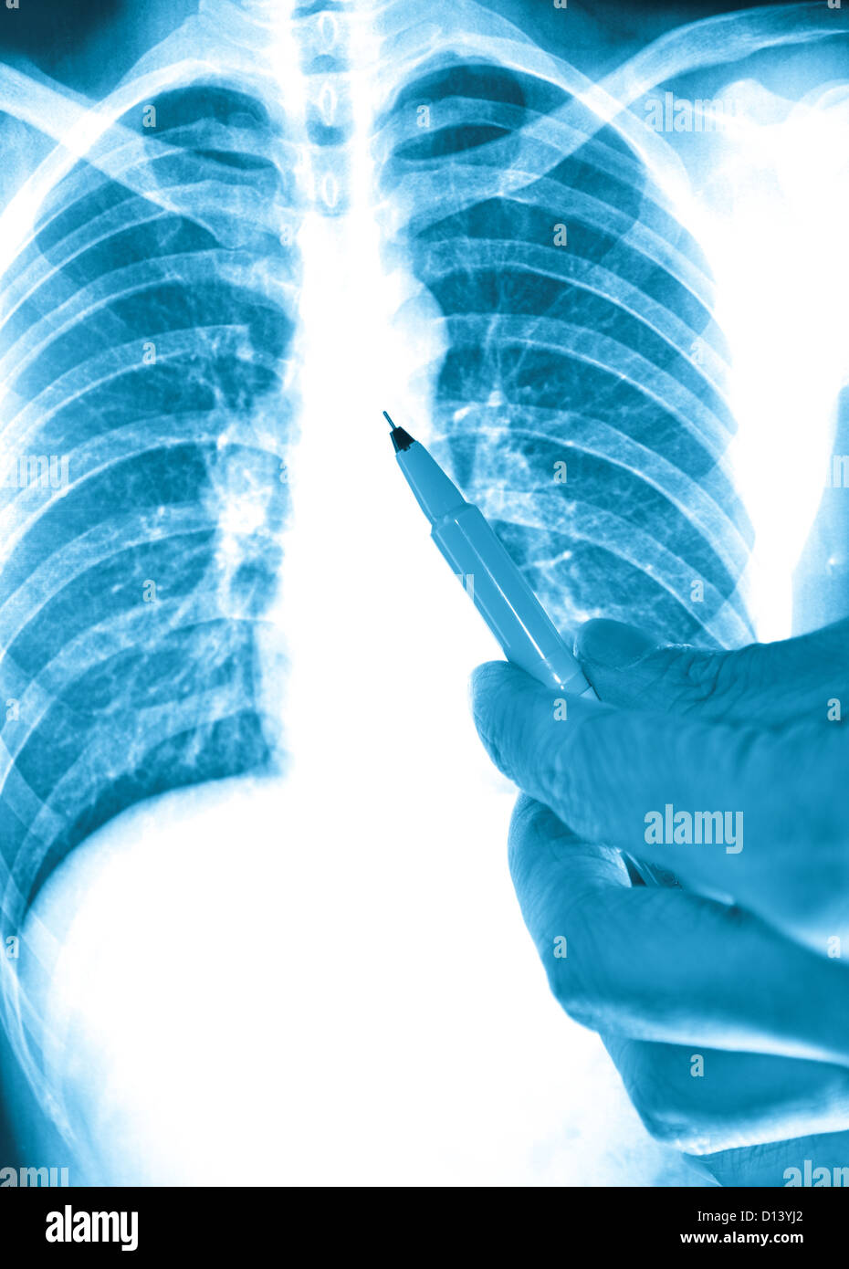 showing x-ray picture of human lumbar vertebra bone Stock Photo