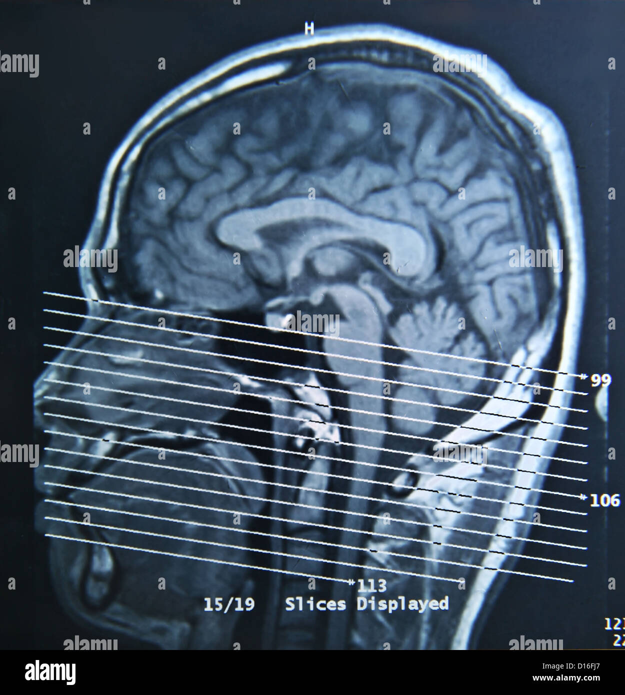 A magnetic resonance imaging scan of the human brain. Stock Photo