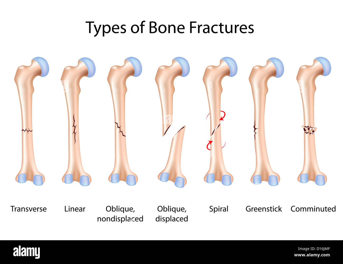 Types of bone fractures Stock Photo