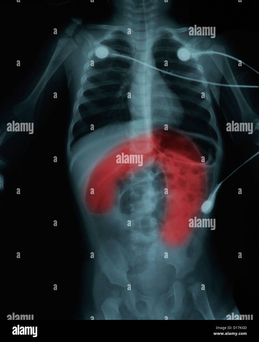 Body xray of 11 month child with bowel obstruction Stock Photo Alamy