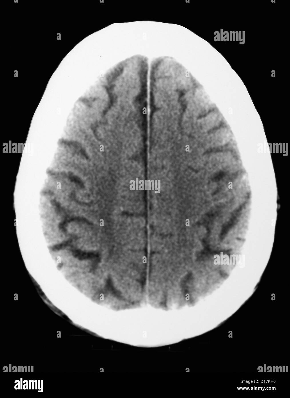 CT scan of elderly man with old occipital infarct Stock Photo
