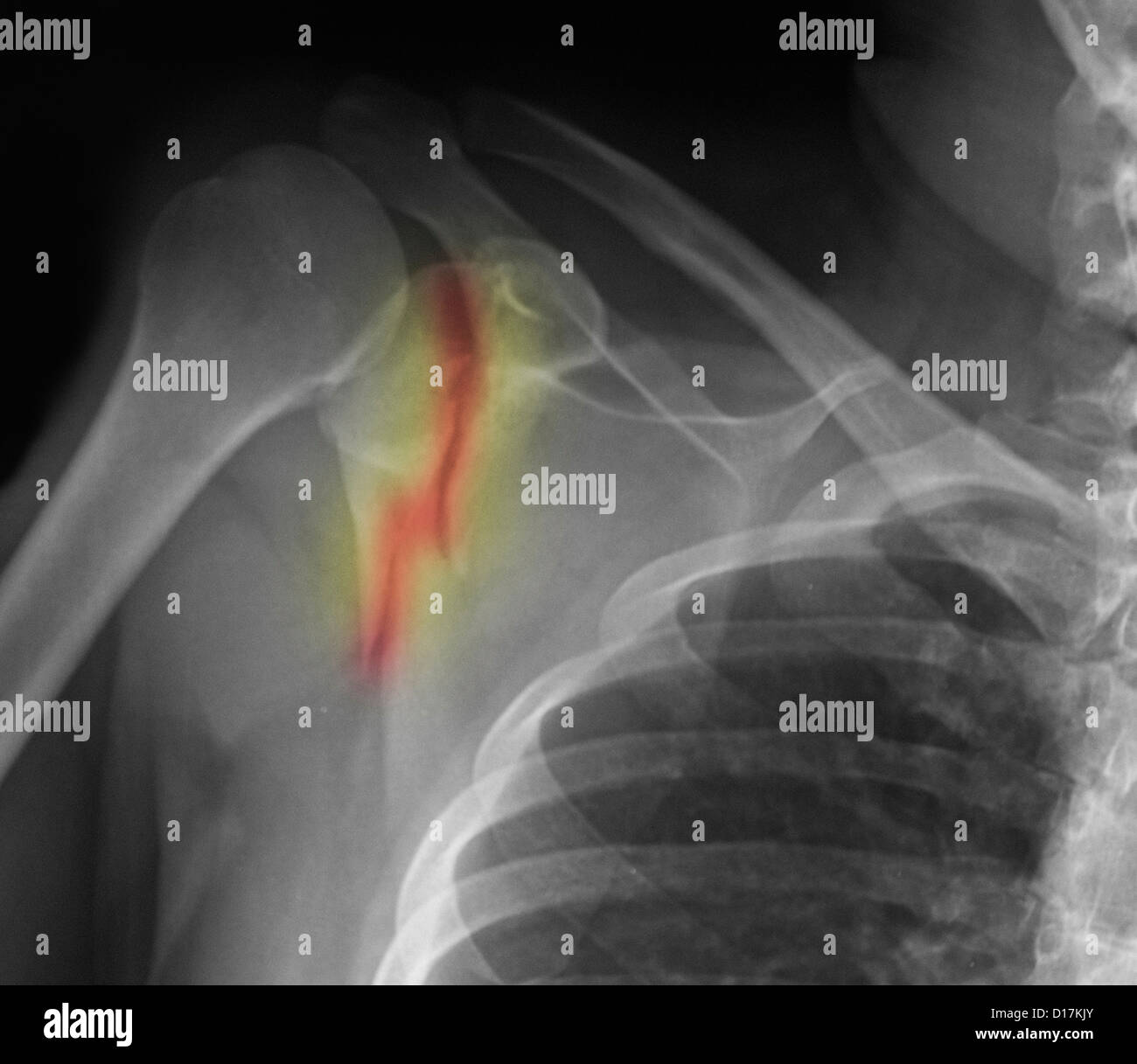 Xray of shoulder with fractured scapula Stock Photo Alamy