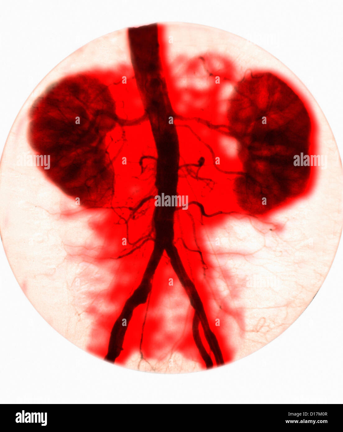 Kidney arteriogram of normal kidneys Stock Photo