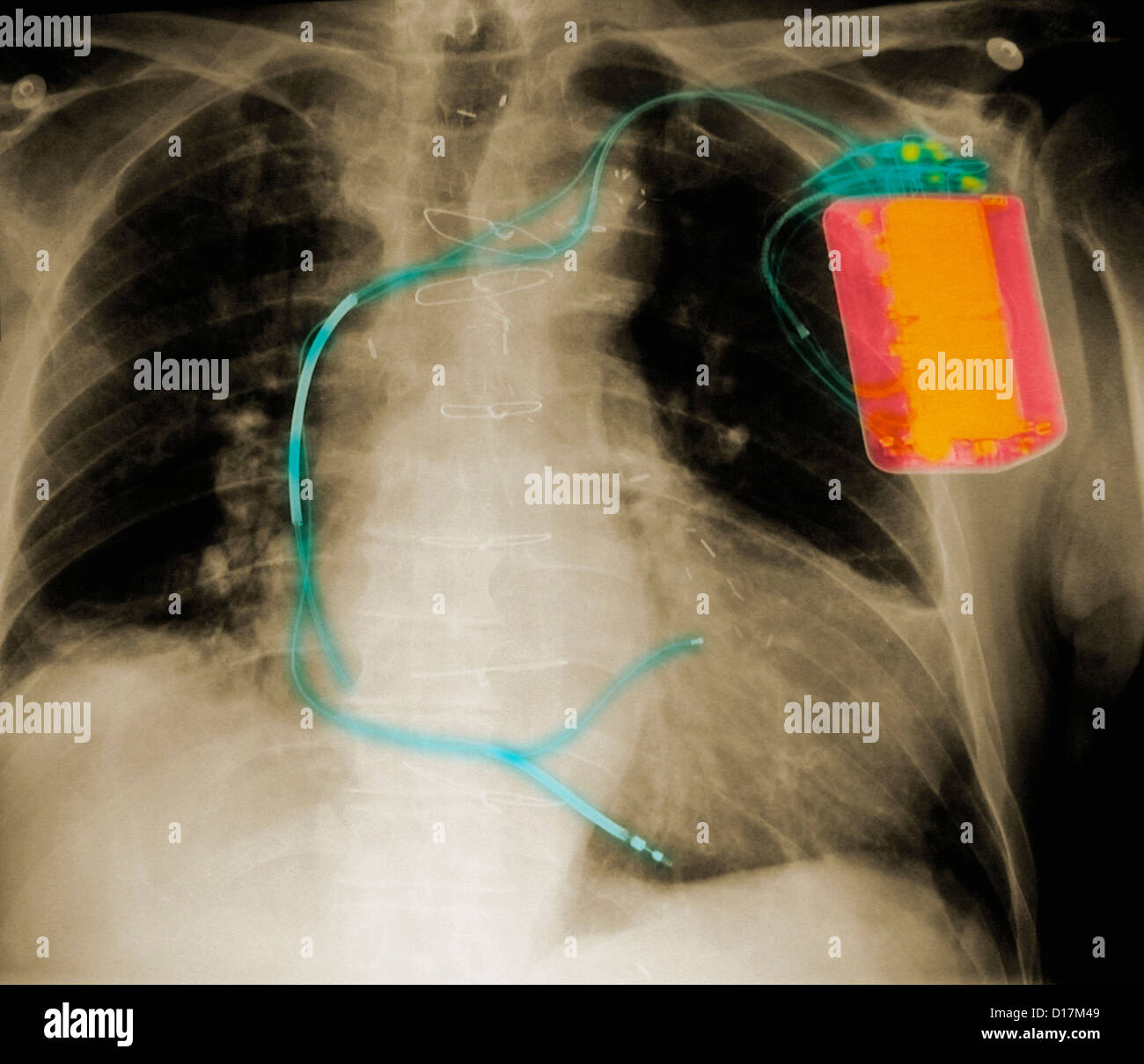 Xray of chest with defibrillator Stock Photo Alamy