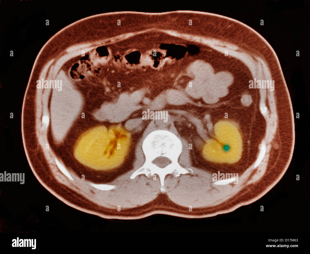 CT scan of abdomen with small kidney stone Stock Photo