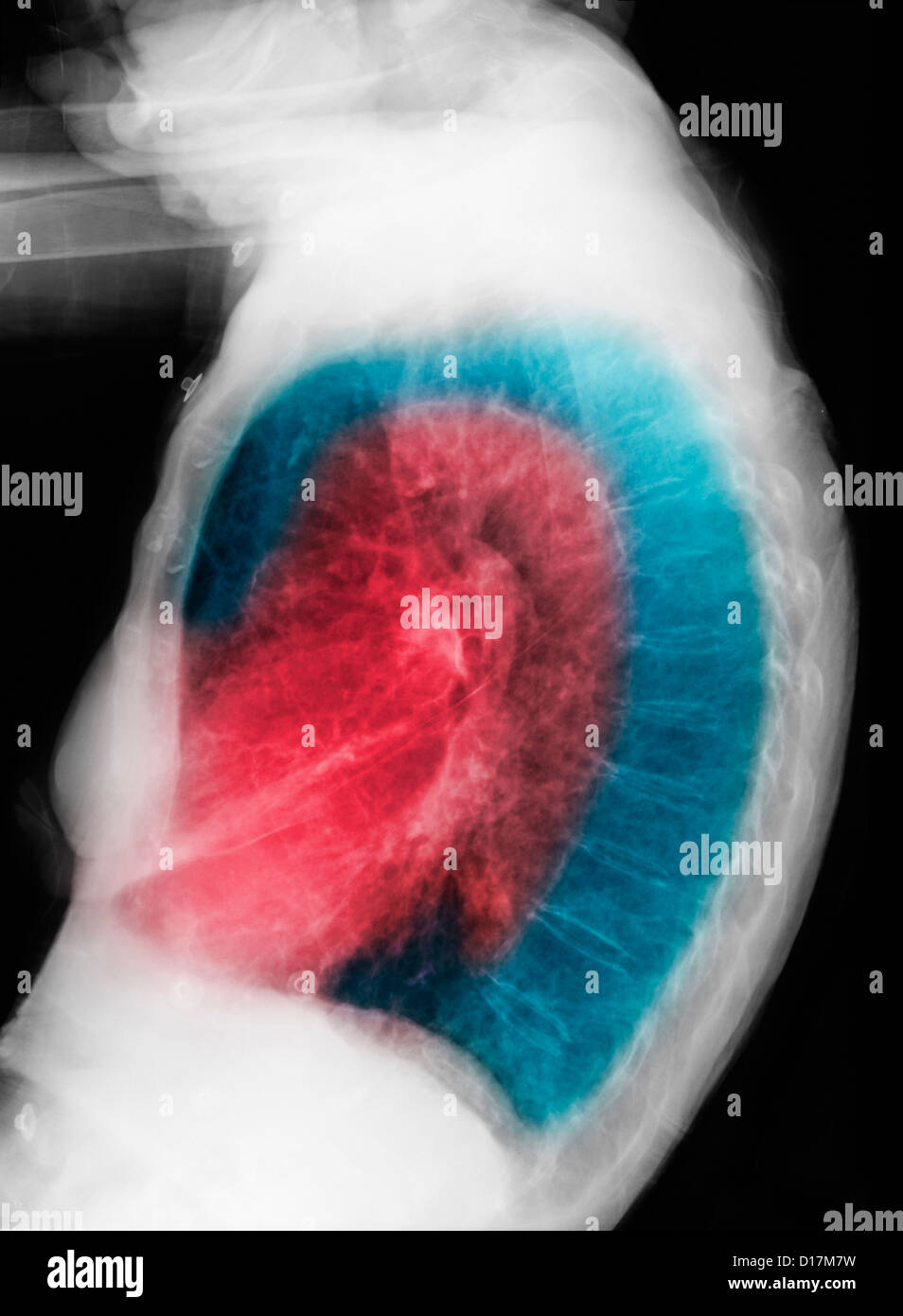 CXR of elderly woman smoker with COPD Stock Photo