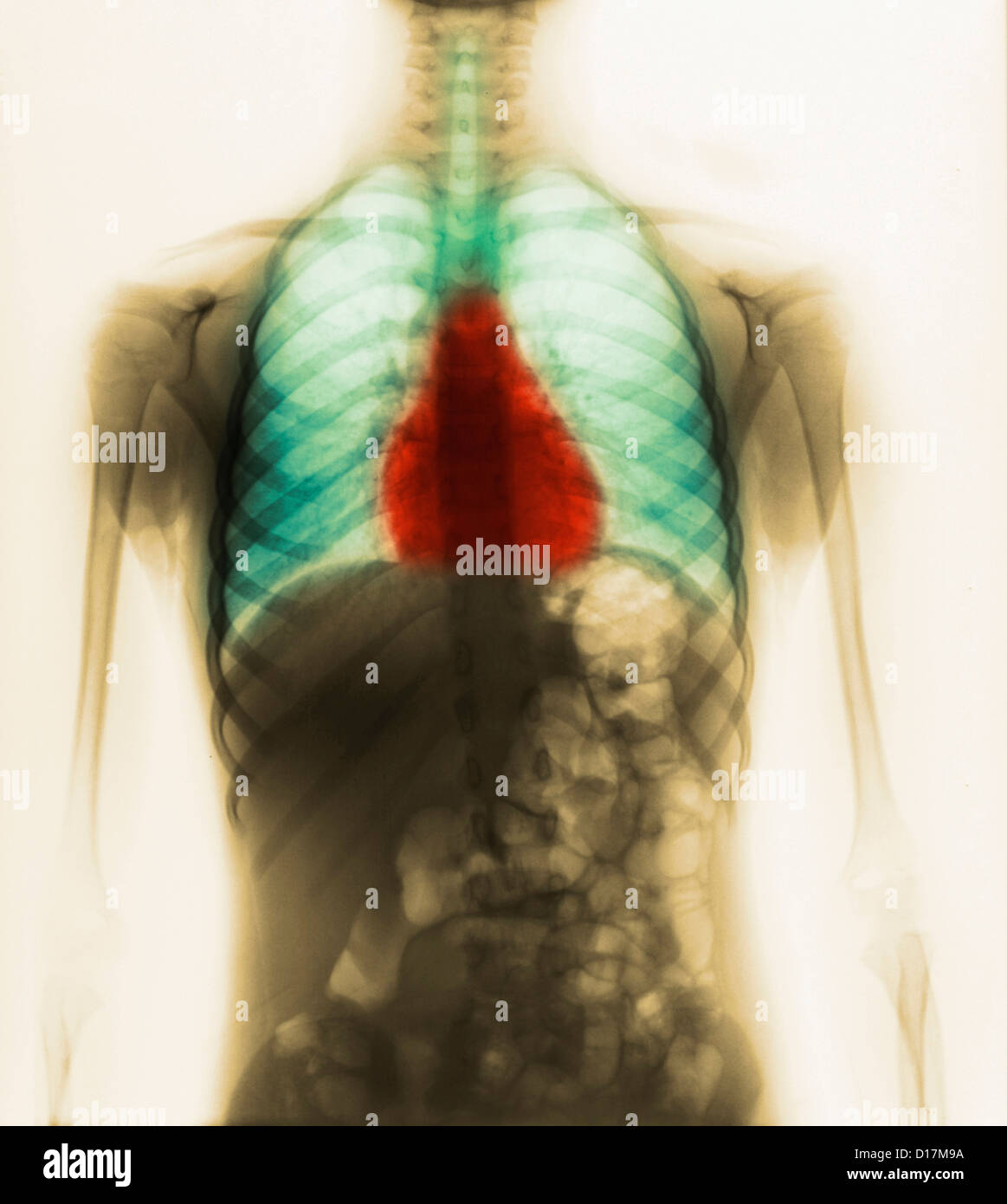 Normal chest X-ray of an 7 year 10 month old girl Stock Photo - Alamy