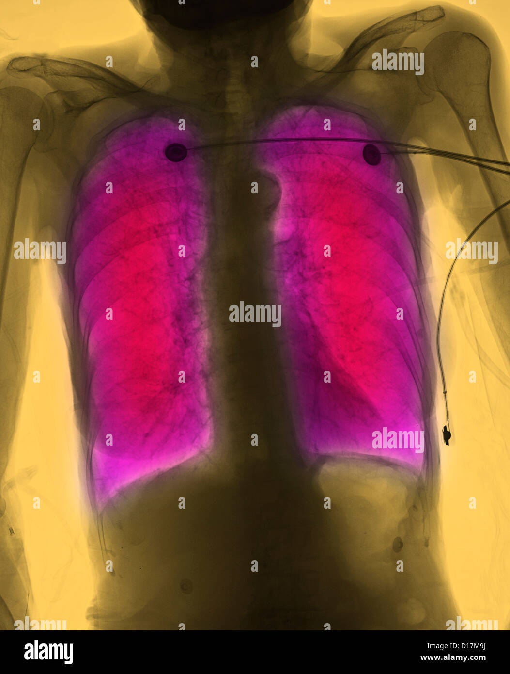 CXR of elderly woman smoker with COPD Stock Photo