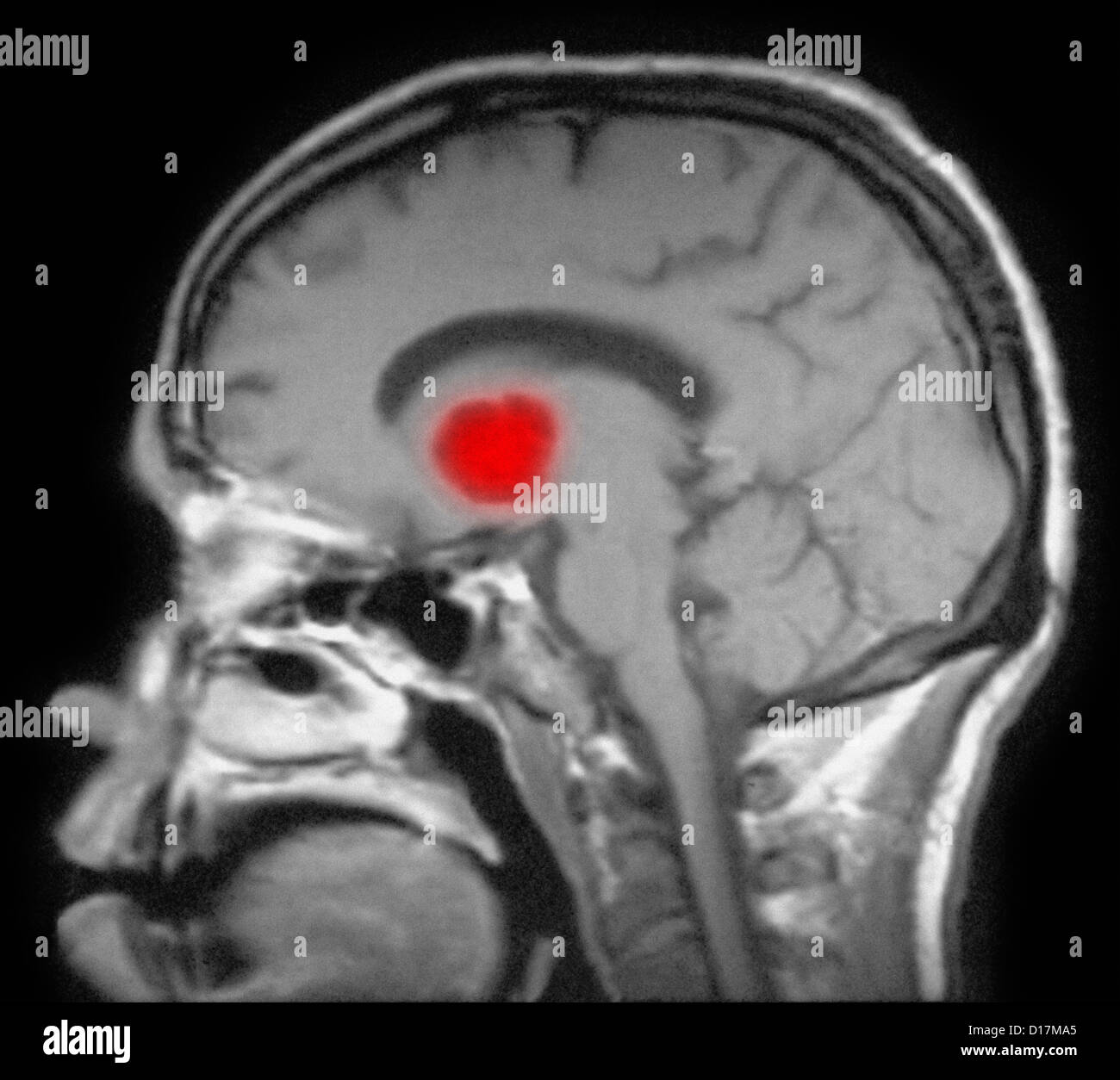 Cryptococcal meningitis in patient with AIDS Stock Photo