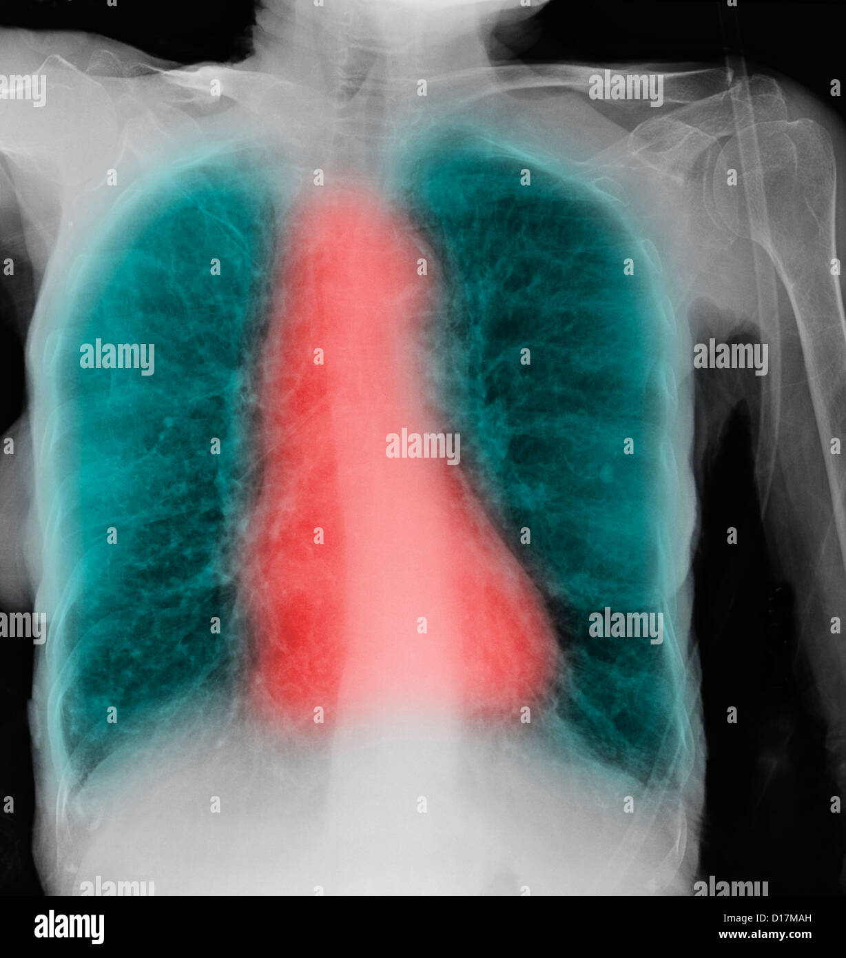 CXR of elderly woman smoker with COPD Stock Photo