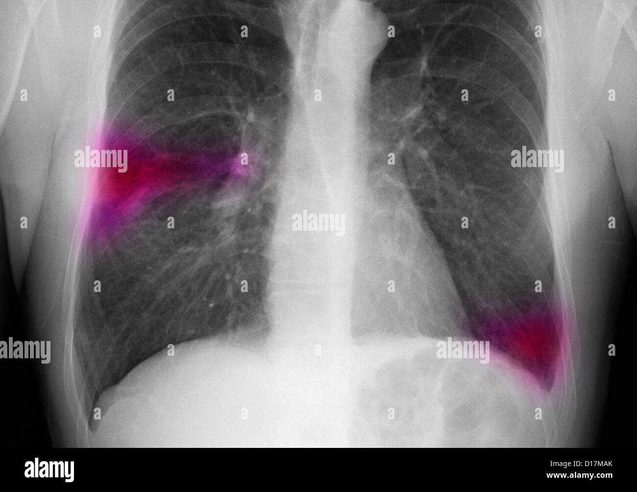 Chest Xray of man with infiltrate in right lung Stock Photo 52415403