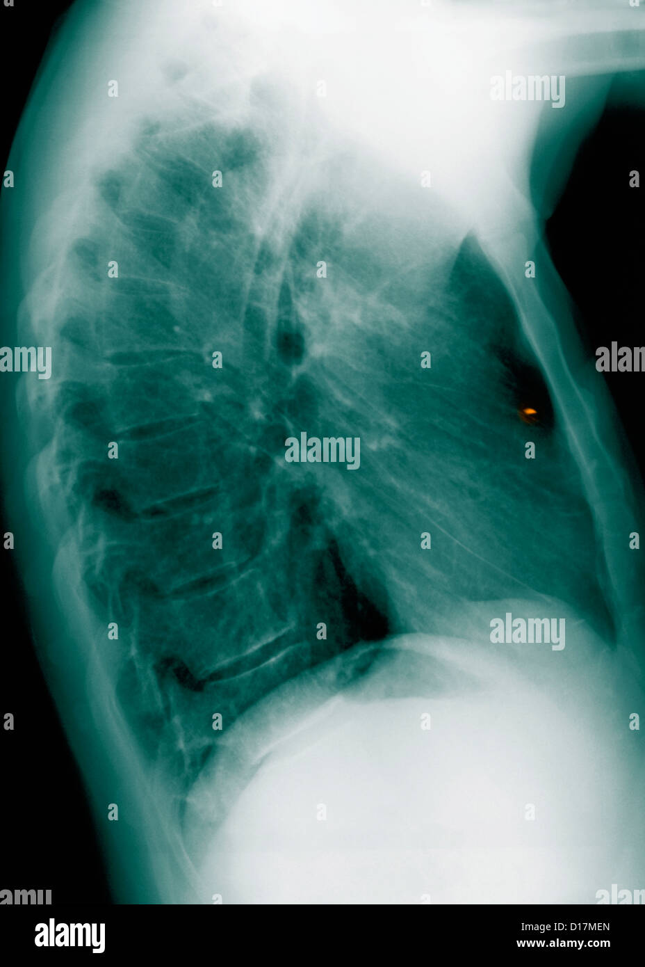 Chest X-ray metal foreign body in lung Stock Photo