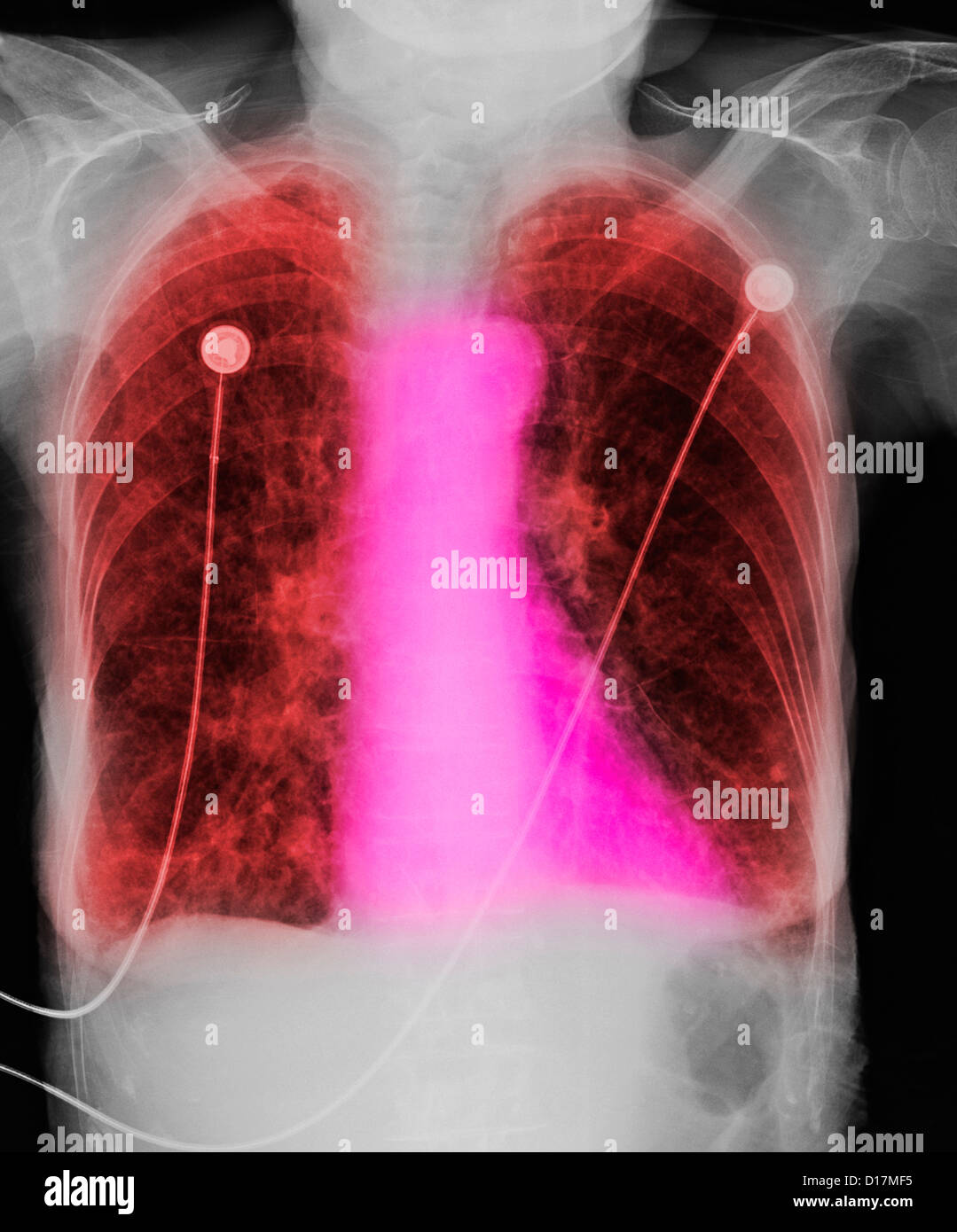 CXR of elderly woman smoker with COPD Stock Photo