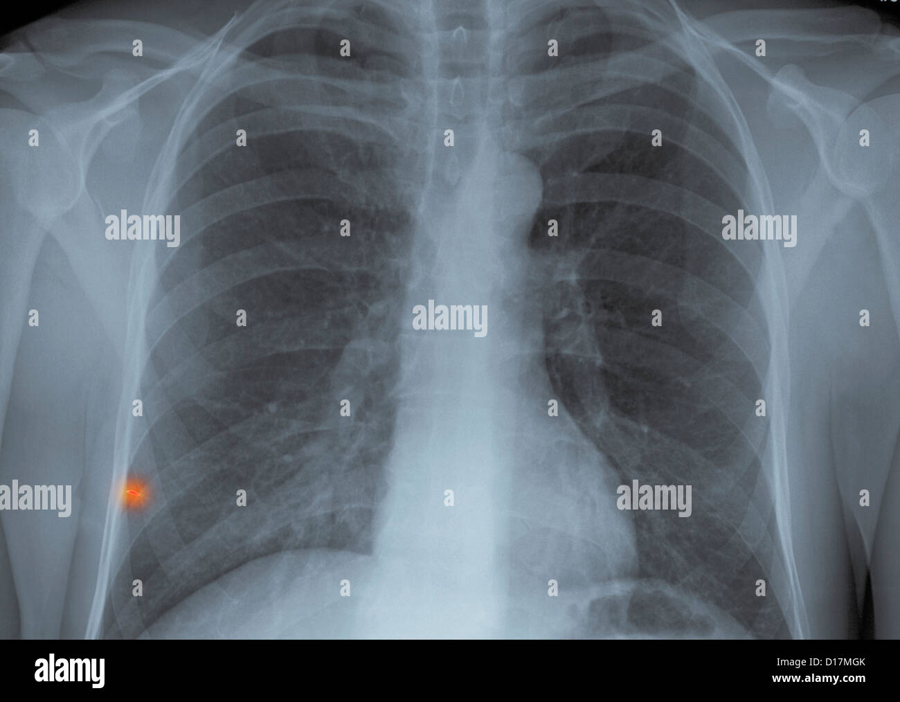 Chest Xray metal foreign body in lung Stock Photo Alamy