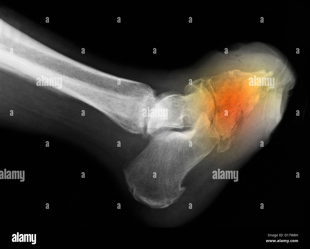 Foot X-ray showing amputation for diabetes Stock Photo