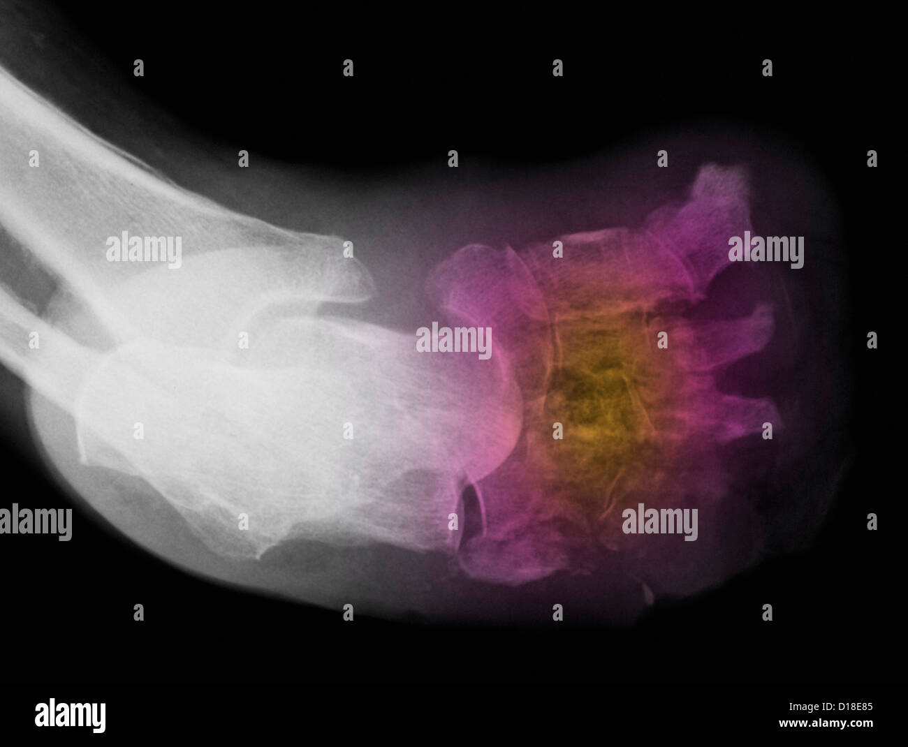 Foot X-ray showing amputation for diabetes Stock Photo