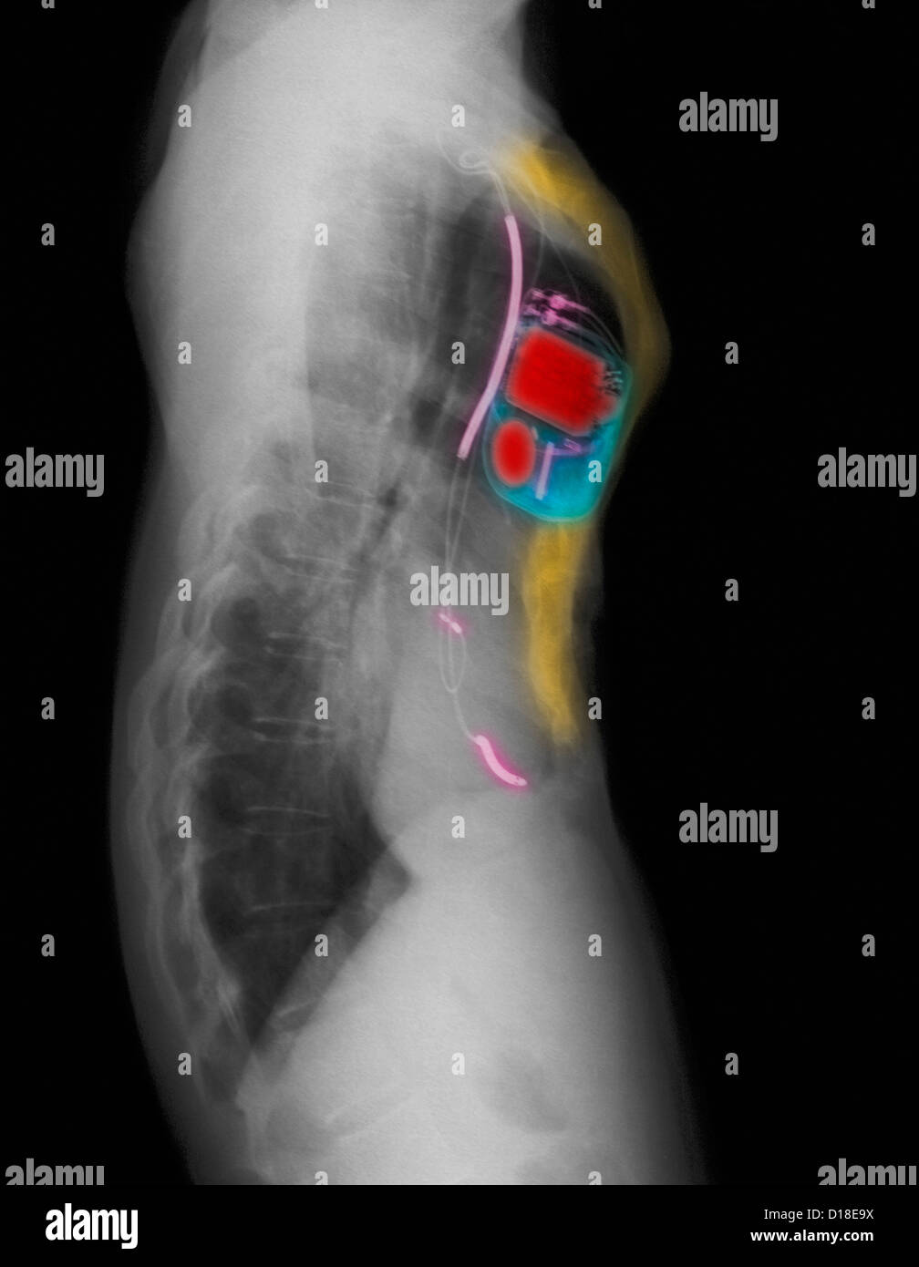 CXR of pacemaker, pectus excavatum chest deformity Stock ...