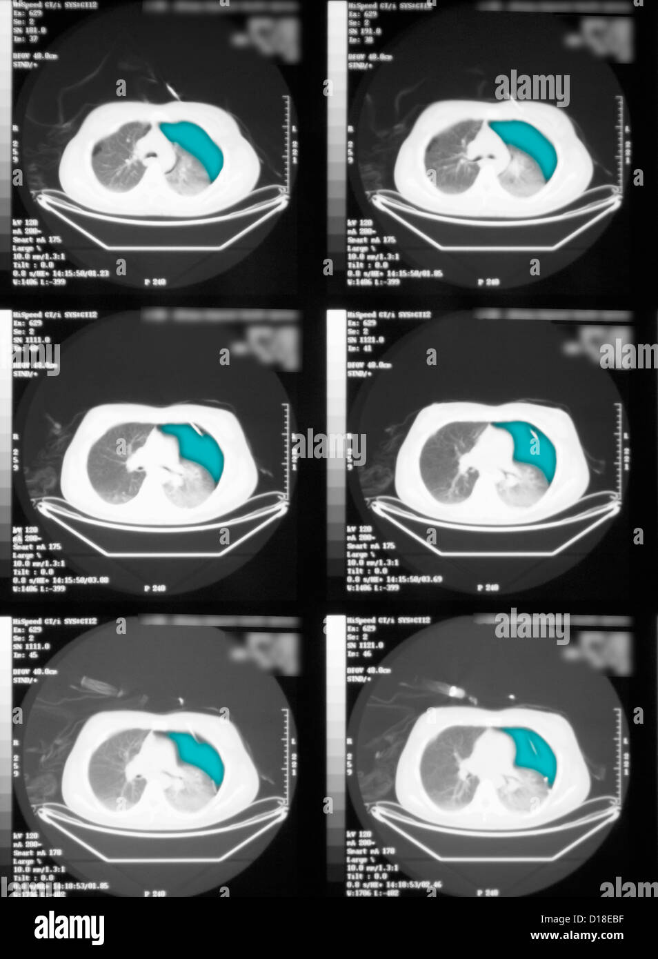 CT scan, pneumothorax of the left lung Stock Photo Alamy