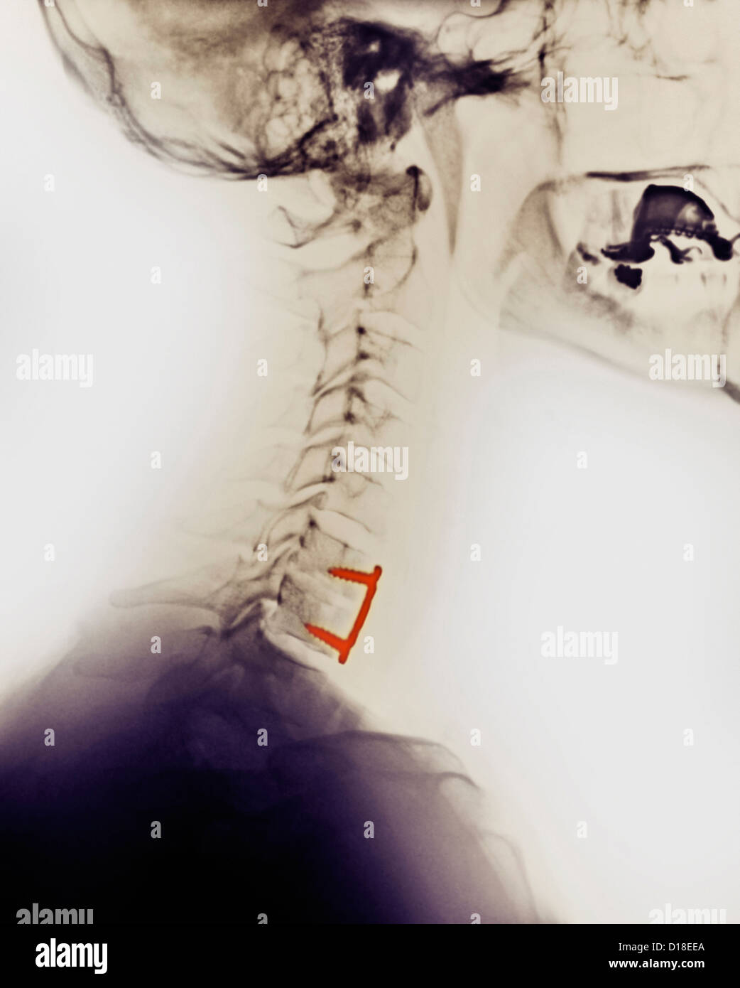 Cervical spine hi-res stock photography and images - Alamy
