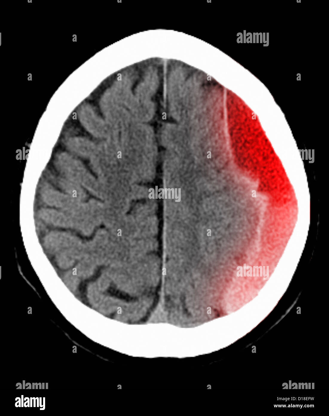 CT scan of the head with subdural hematoma Stock Photo