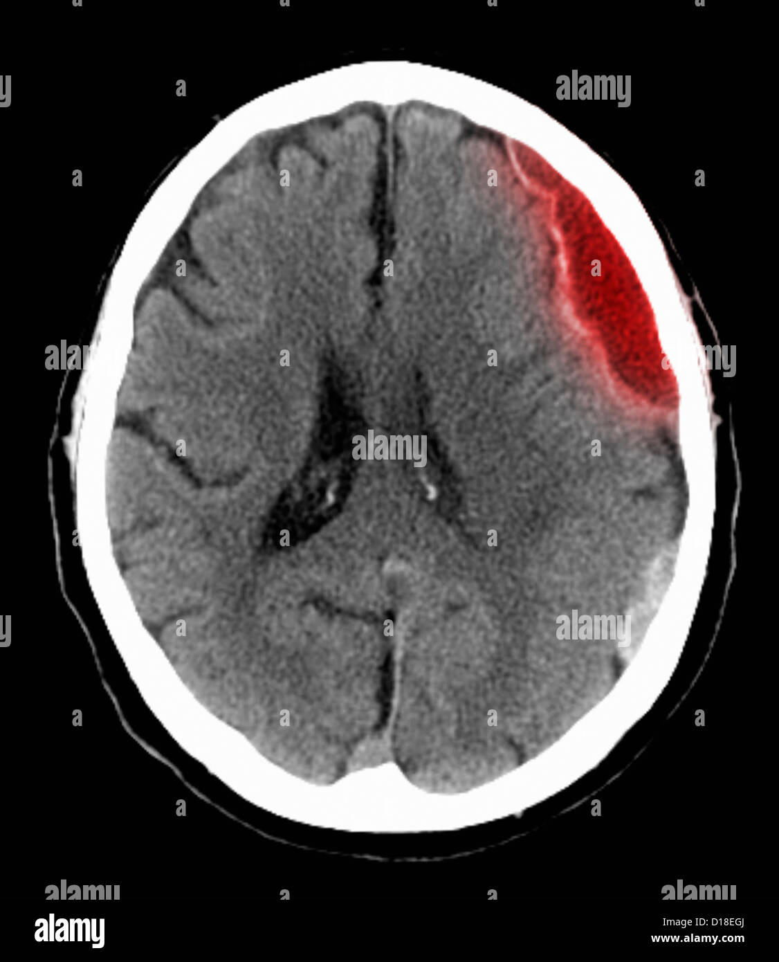 CT scan of the head with subdural hematoma Stock Photo