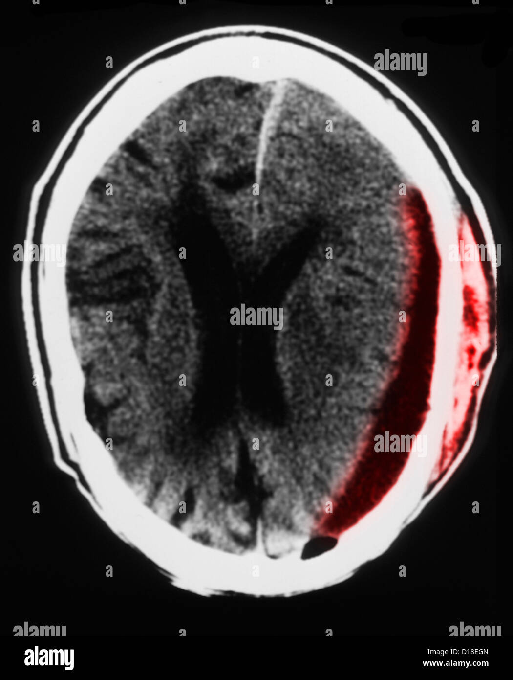 Head CT scan with subdural hematoma, atrophy Stock Photo