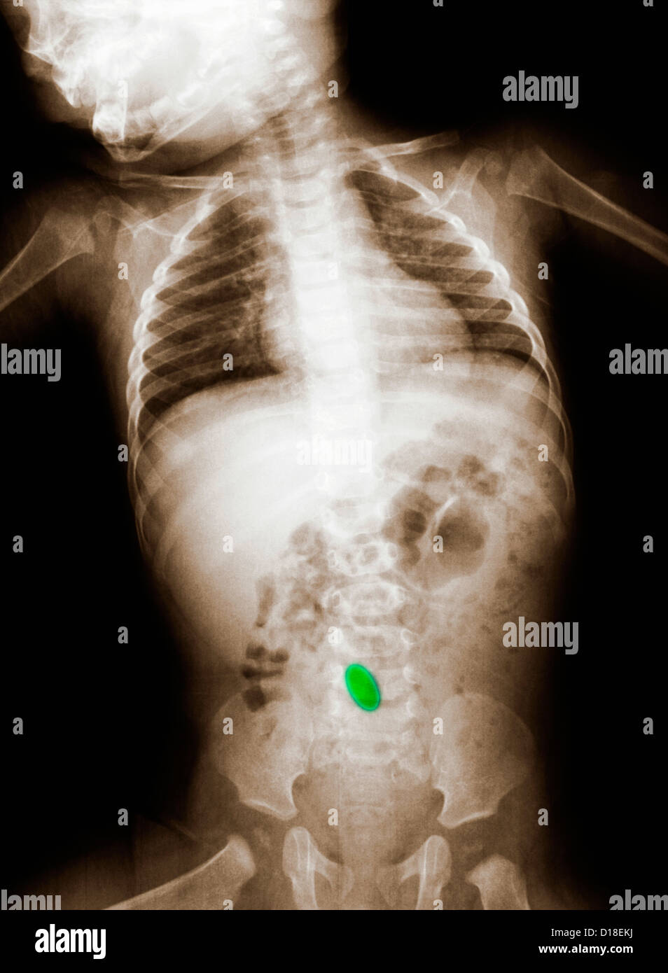 Abdominal Xray of infant, with swallowed object Stock Photo 52432902