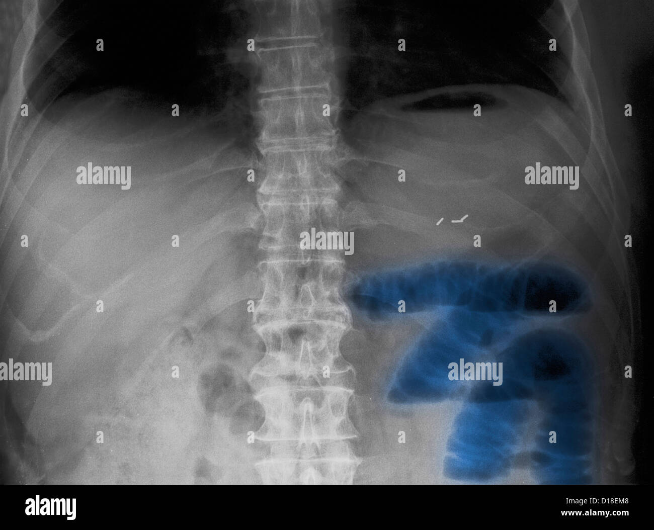 Abdominal X-ray, small bowel obstruction Stock Photo