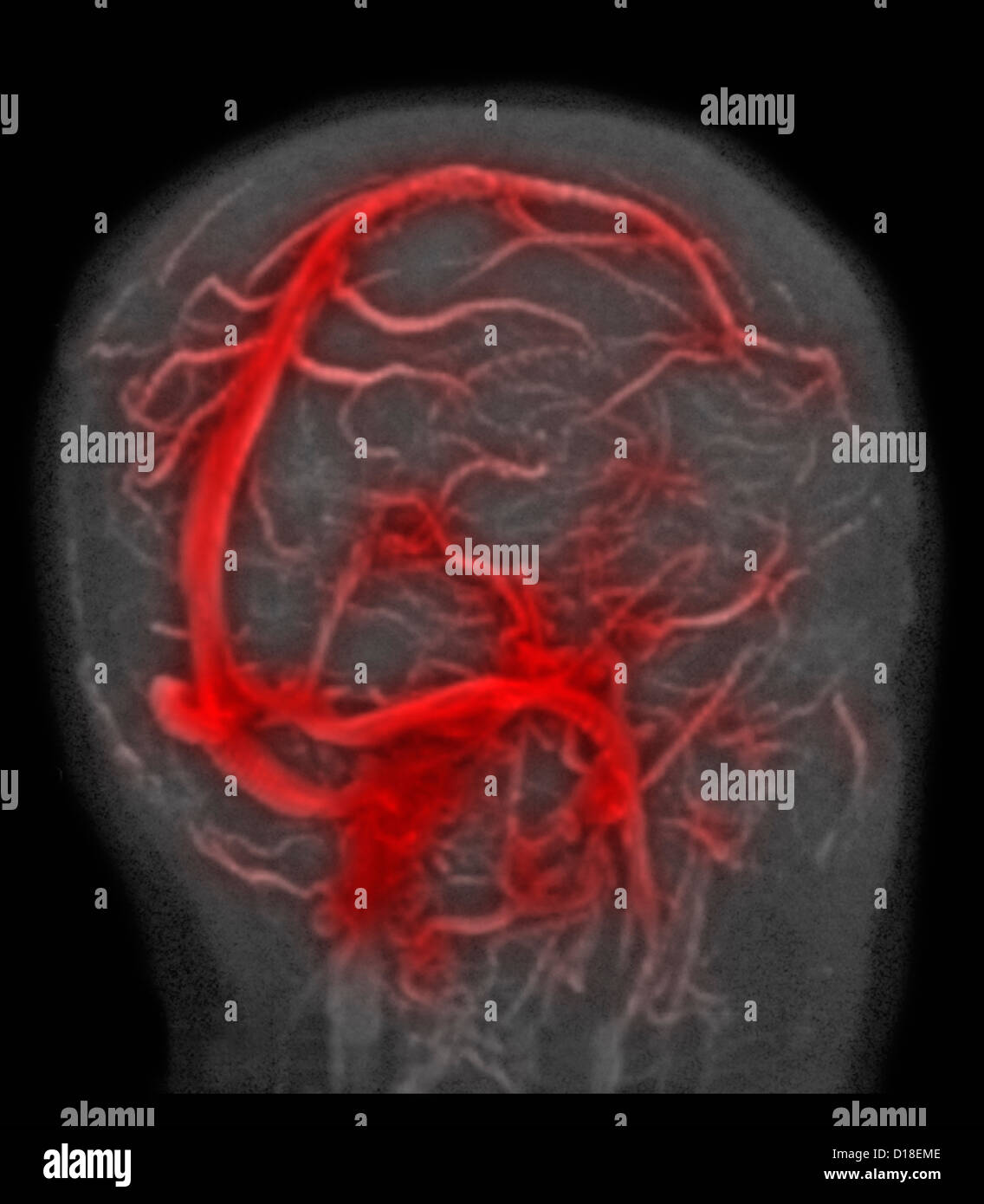 Normal brain MRI, magnetic resonance venography Stock Photo