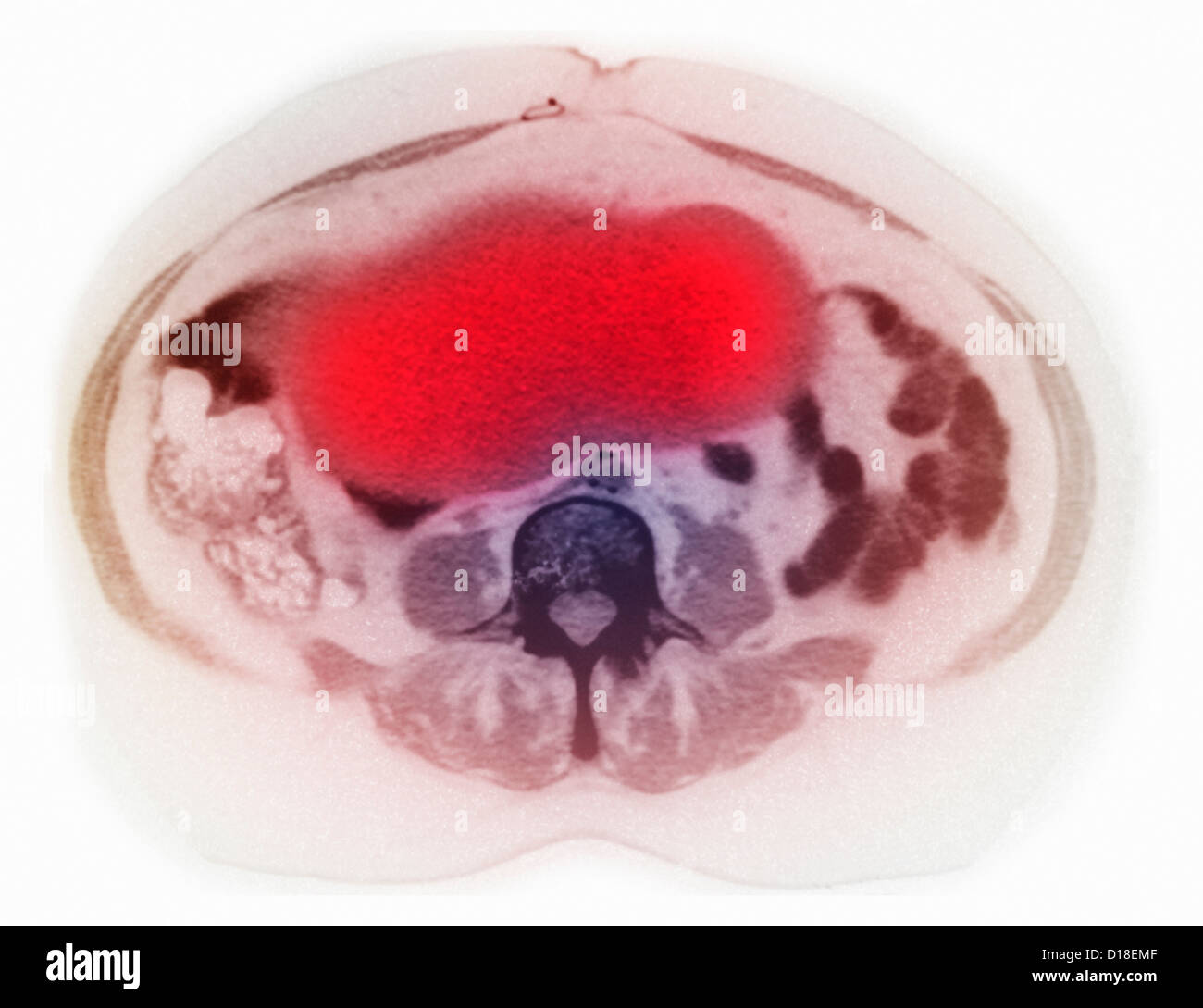 Ovarian cancer on CT scan Stock Photo