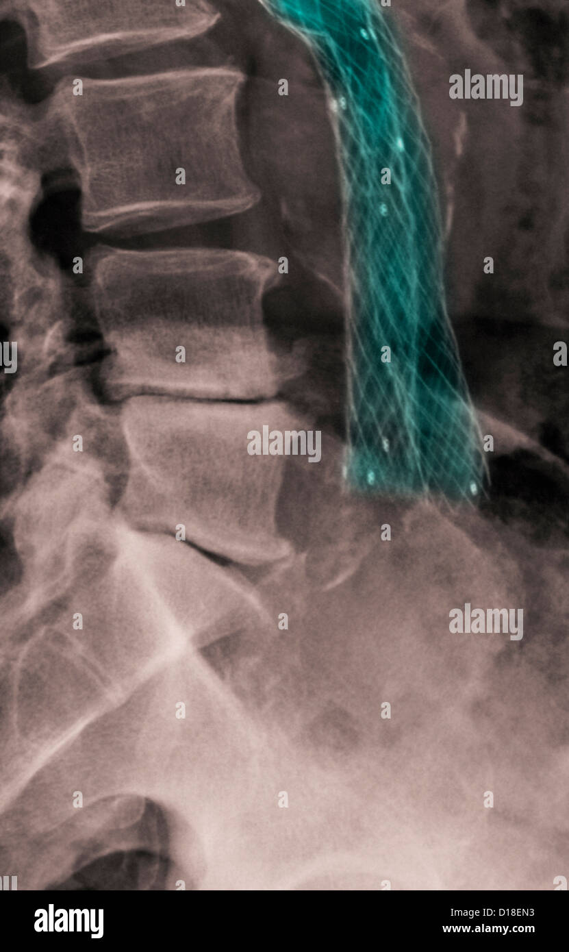 X-ray showing a wiremesh aorto-iliac bypass graft Stock Photo