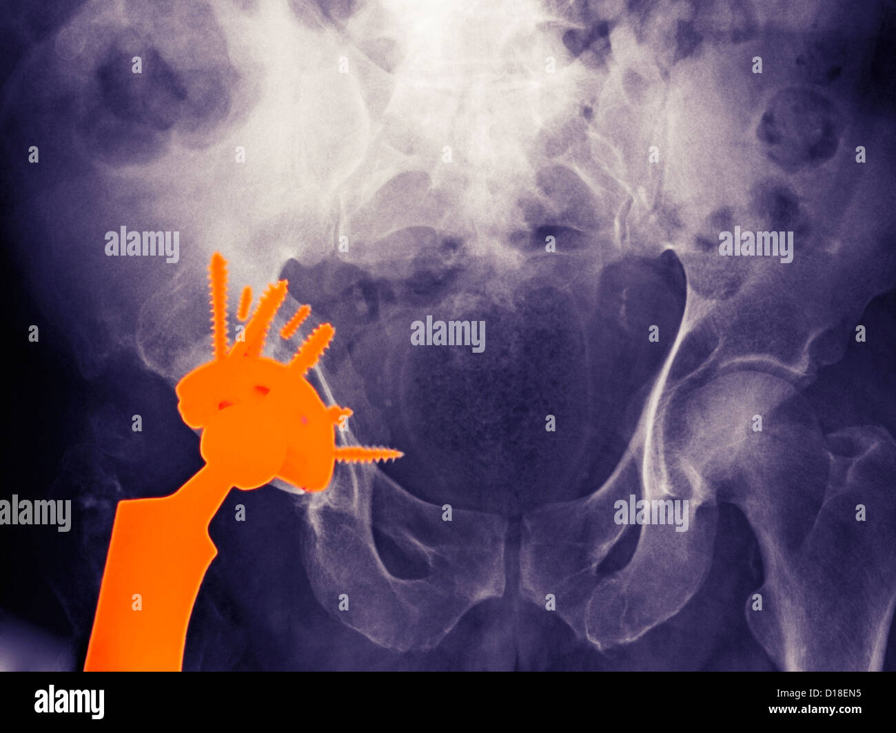 X-ray of a hip replacement in a 56 year old man Stock Photo