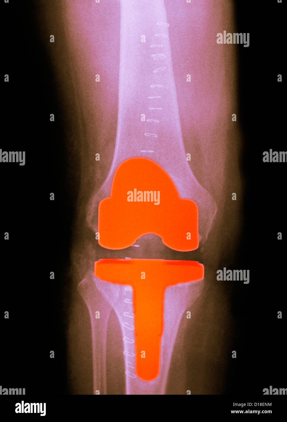 knee replacement in a 61 year old female Stock Photo