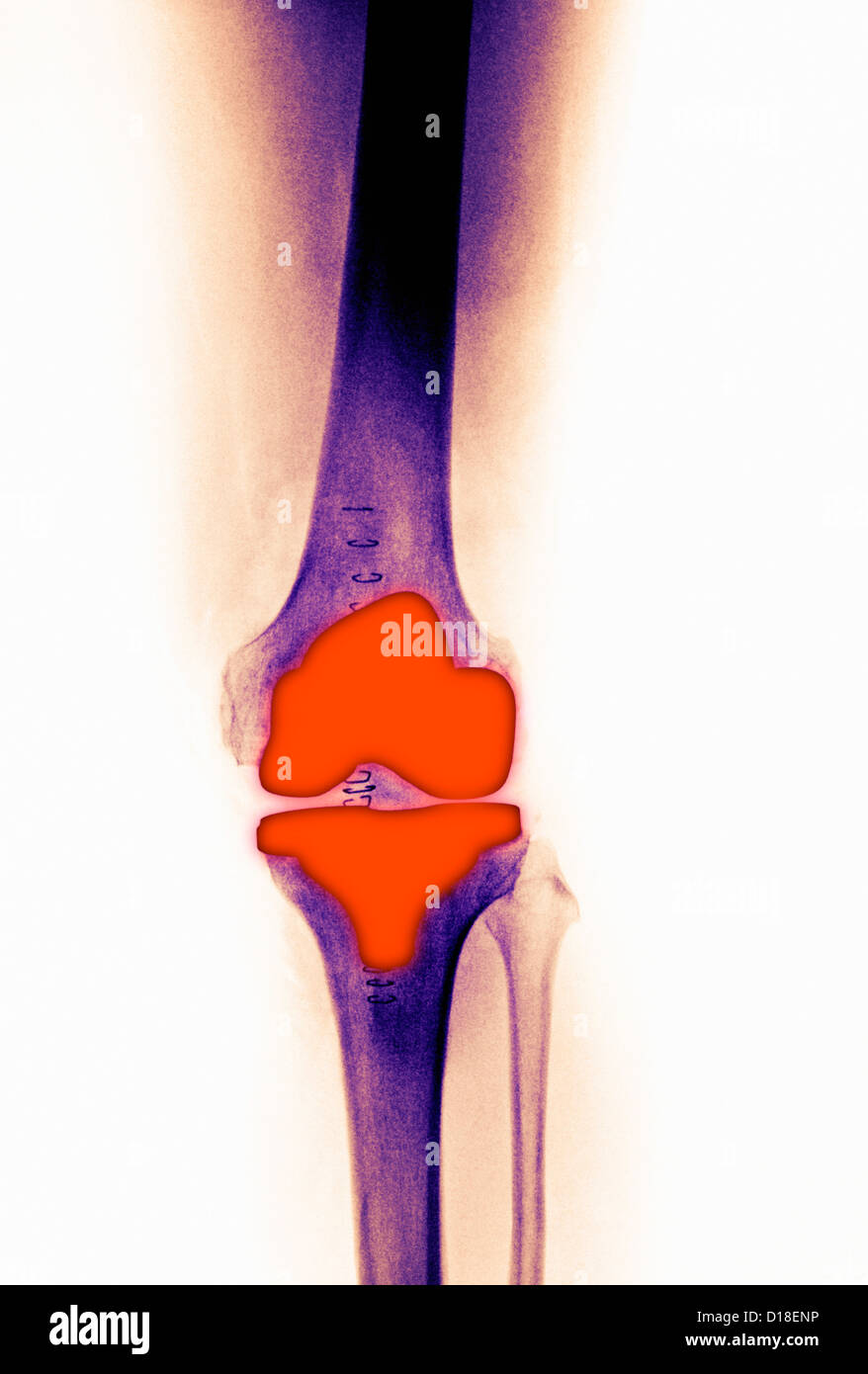 knee replacement in a 61 year old female Stock Photo