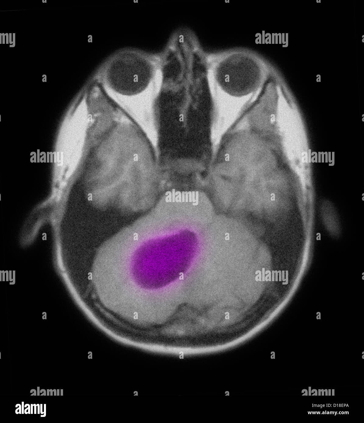 MRI of the brain showing an astrocytoma tumor Stock Photo
