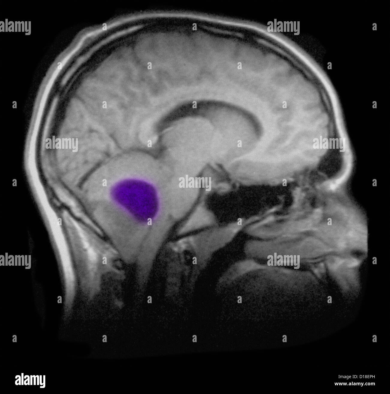 MRI of the brain showing an astrocytoma tumor Stock Photo