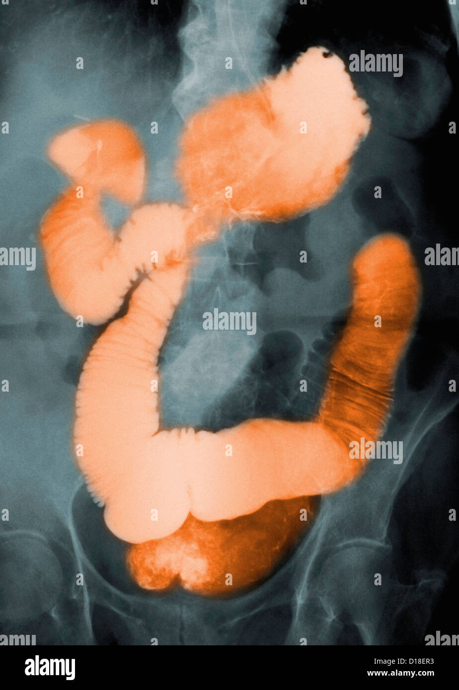 Barium contrast Xray of the abdomen Stock Photo Alamy