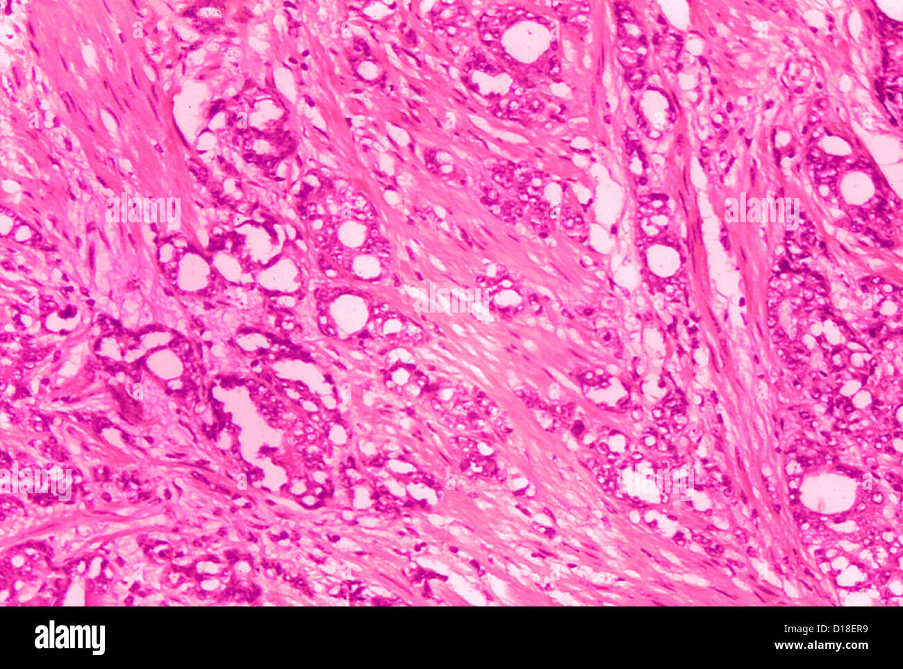 Histopathology of adenocarcinoma of the prostate Stock Photo