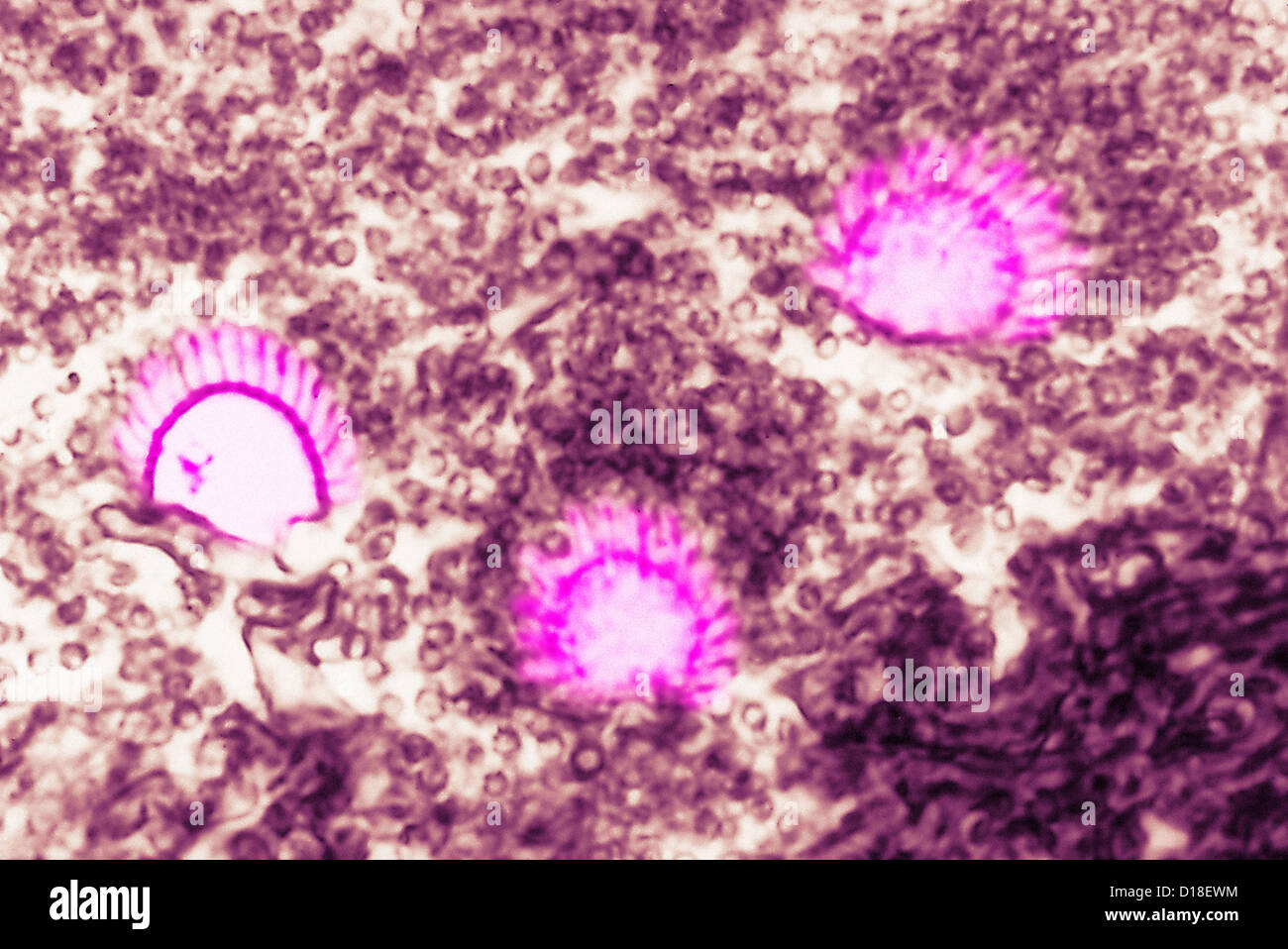 light micrograph,  pulmonary aspergillosis Stock Photo