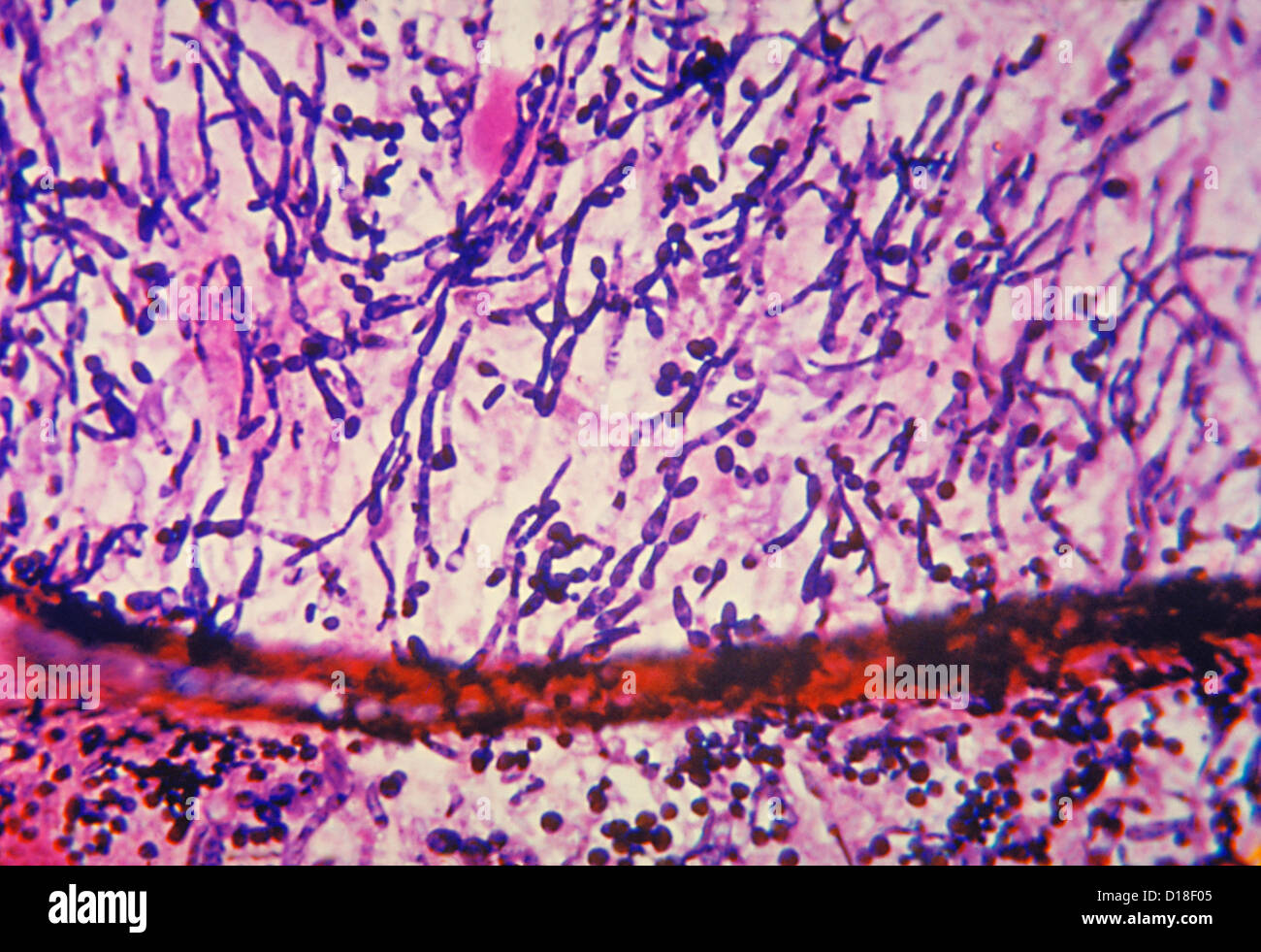 Light micrograph of Candida fungus Stock Photo