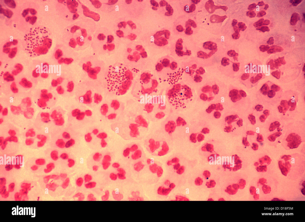 Photomicrograph of gonococcal urethritis Stock Photo