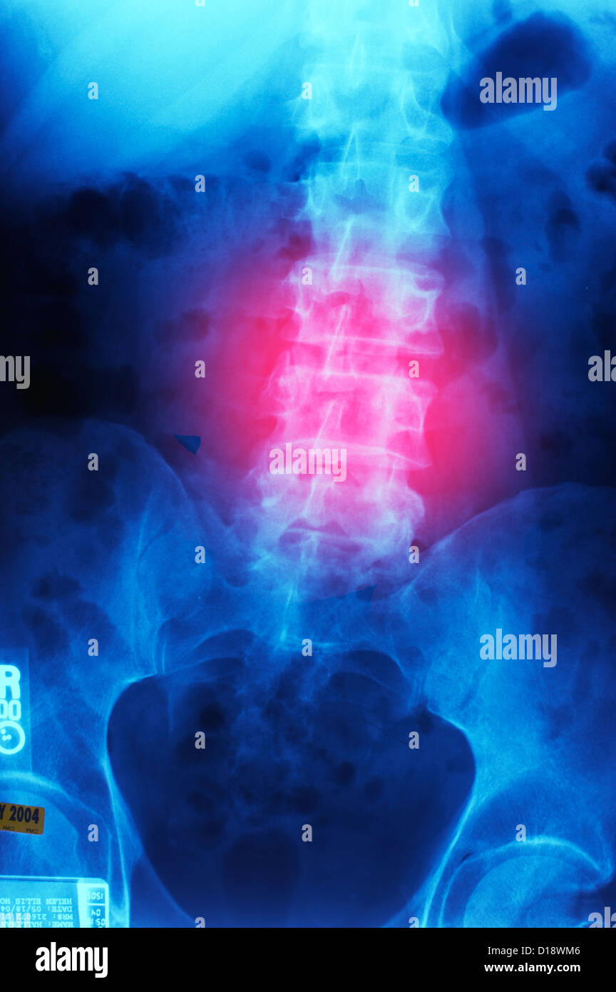 Human spine pain hi-res stock photography and images - Alamy